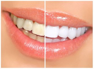 whitening teeth.jpg